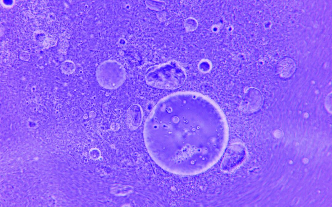 Améloblastome