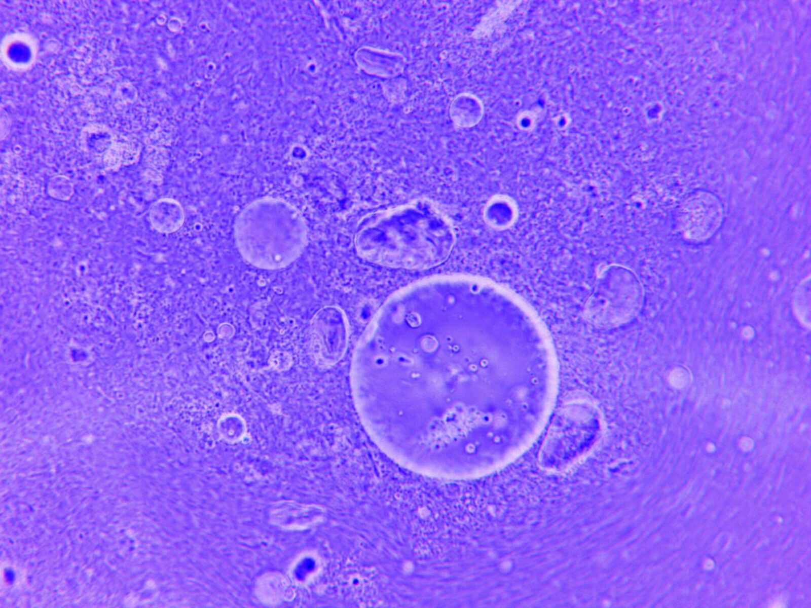 Améloblastome