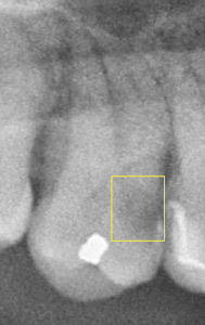 Carie sur 17 vue par WeDiagnostiX