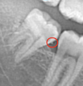 tarte sur radiographie tartre détecté par WeDiagnostix